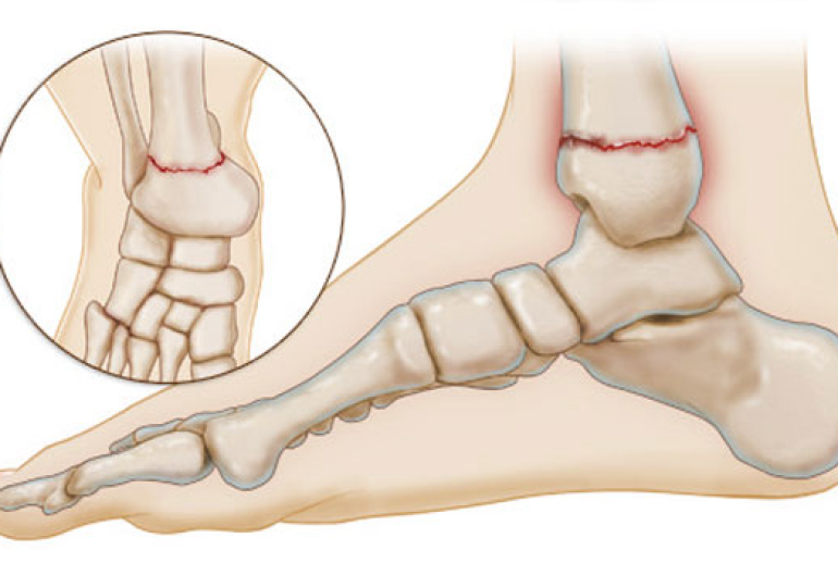 دکتر شکستگی مچ پا - ( مشهد
